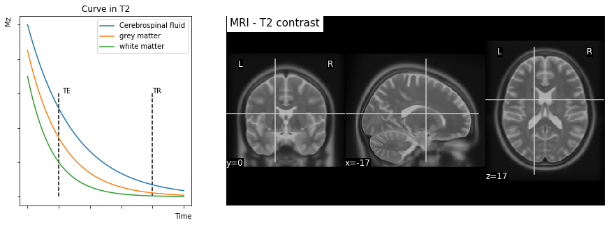 ../../../_images/mri_intro_9_0.png