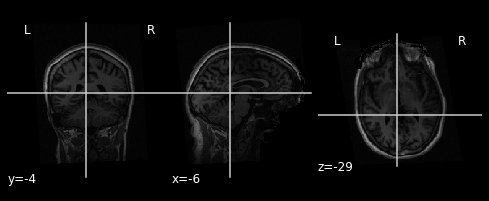 ../../../_images/statistical_analyses_MRI_7_2.png